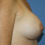 Breast Augmentation Before & After Patient #7111