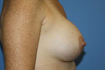 Breast Augmentation Before & After Patient #7111