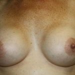 Breast Augmentation Before & After Patient #7111