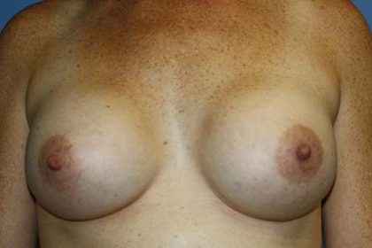 Breast Augmentation Before & After Patient #7111