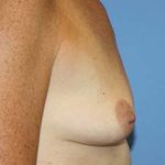 Breast Augmentation Before & After Patient #7111