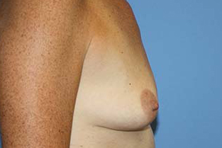 Breast Augmentation Before & After Patient #7111