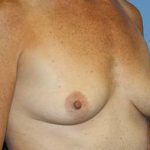 Breast Augmentation Before & After Patient #7111