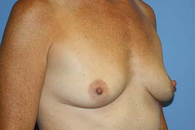 Breast Augmentation Before & After Patient #7111