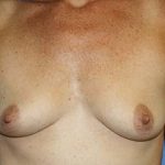 Breast Augmentation Before & After Patient #7111