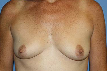 Breast Augmentation Before & After Patient #7111