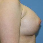 Breast Augmentation Before & After Patient #5617