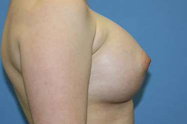 Breast Augmentation Before & After Patient #5617