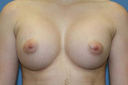 Breast Augmentation Before & After Patient #5617