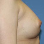 Breast Augmentation Before & After Patient #5617