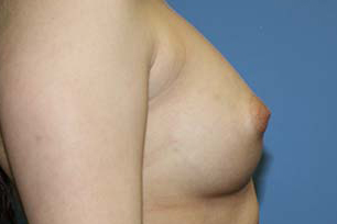 Breast Augmentation Before & After Patient #5617