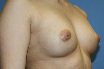 Breast Augmentation Before & After Patient #5617