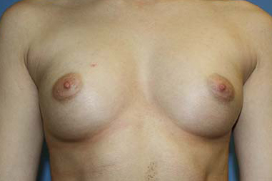 Breast Augmentation Before & After Patient #5617