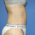 Tummy Tuck Before & After Patient #5637