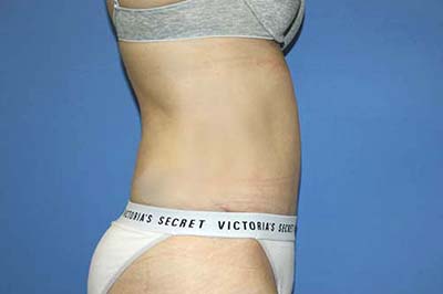 Tummy Tuck Before & After Patient #5637