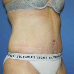 Tummy Tuck Before & After Patient #5637