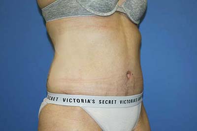 Tummy Tuck Before & After Patient #5637