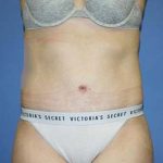 Tummy Tuck Before & After Patient #5637