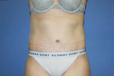 Tummy Tuck Before & After Patient #5637