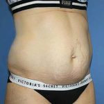 Tummy Tuck Before & After Patient #5637