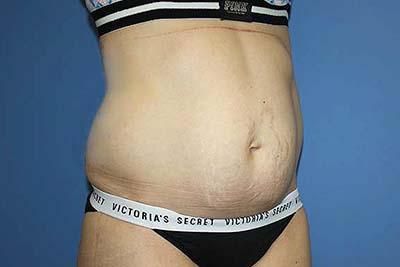 Tummy Tuck Before & After Patient #5637