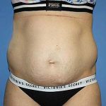 Tummy Tuck Before & After Patient #5637