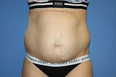 Tummy Tuck Before & After Patient #5637