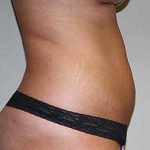 Tummy Tuck Before & After Patient #7244