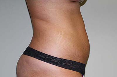 Tummy Tuck Before & After Patient #7244