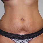 Tummy Tuck Before & After Patient #7244