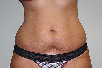 Tummy Tuck Before & After Patient #7244