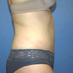 Tummy Tuck Before & After Patient #5645