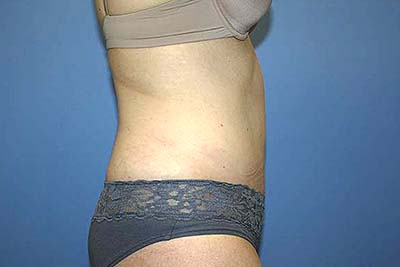 Tummy Tuck Before & After Patient #5645