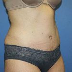 Tummy Tuck Before & After Patient #5645