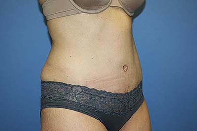 Tummy Tuck Before & After Patient #5645