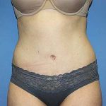 Tummy Tuck Before & After Patient #5645