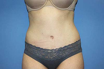 Tummy Tuck Before & After Patient #5645