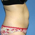 Tummy Tuck Before & After Patient #5645