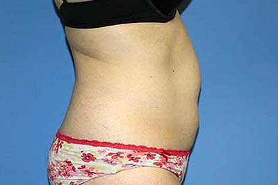 Tummy Tuck Before & After Patient #5645