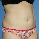 Tummy Tuck Before & After Patient #5645