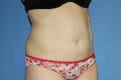 Tummy Tuck Before & After Patient #5645