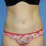 Tummy Tuck Before & After Patient #5645