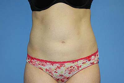 Tummy Tuck Before & After Patient #5645