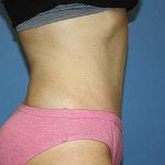 Tummy Tuck Before & After Patient #7243