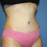 Tummy Tuck Before & After Patient #7243