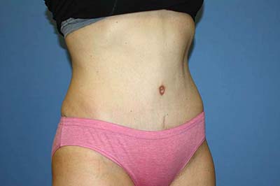 Tummy Tuck Before & After Patient #7243