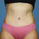 Tummy Tuck Before & After Patient #7243