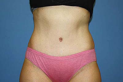 Tummy Tuck Before & After Patient #7243