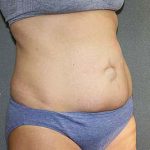 Tummy Tuck Before & After Patient #7243