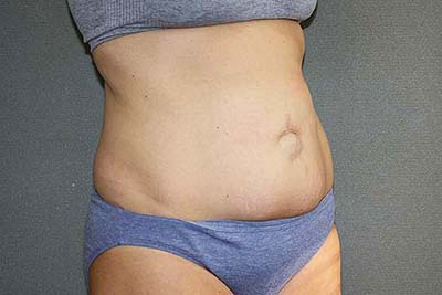 Tummy Tuck Before & After Patient #7243